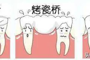 什么是种植牙？(什么是种植牙?有哪些优缺点?)